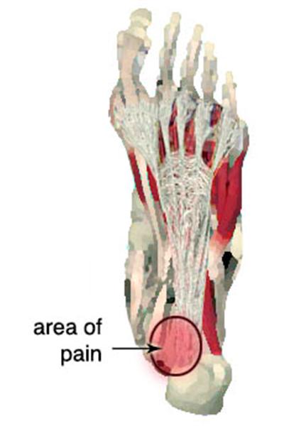 plantar-fascia-pain-area (Custom).jpg