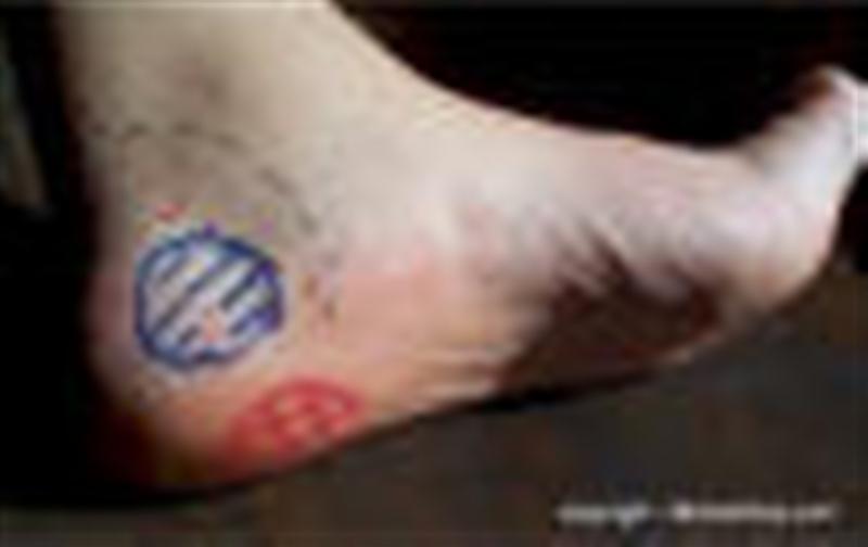 plantar_fasciitis_small (Custom).jpg